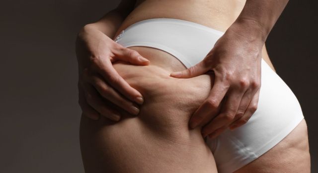 Comment éliminer la cellulite à Paris 14 ?