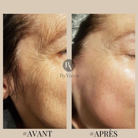 soin visage anti-âge innovant à Paris 14