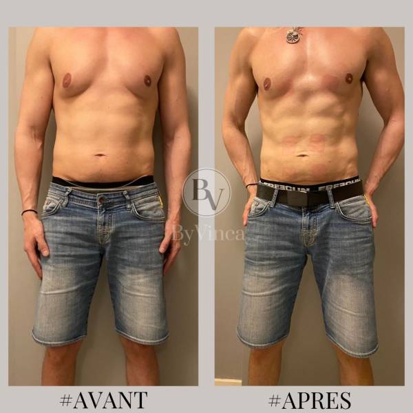 Résultat avant/après d'électrostimulation sur les abdominaux et pecs homme à Paris 14