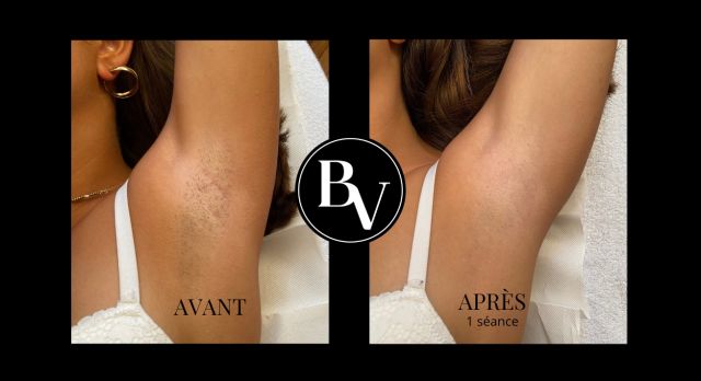 Epilation définitive aisselles avant/après à Paris 14