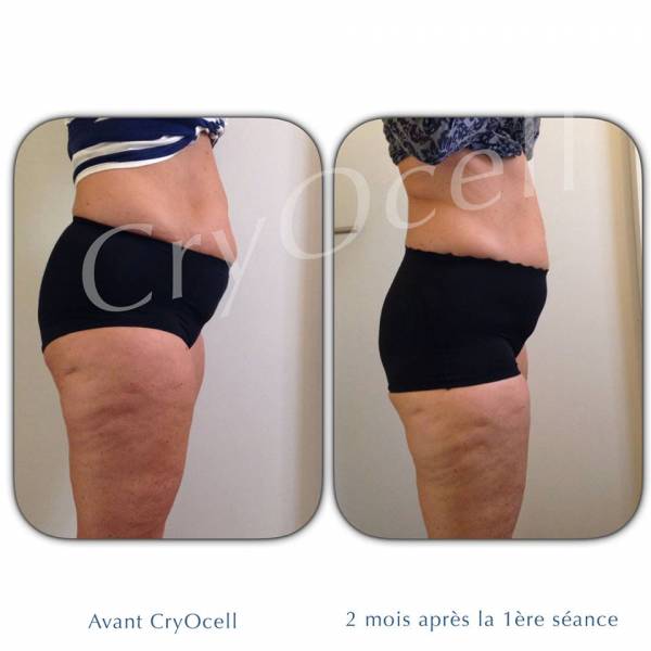 Cryo minceur avant /après Paris 14 Montparnasse