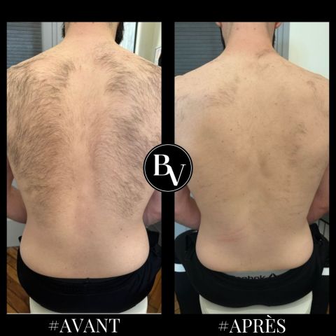 Résultat avant après épilation lumière pulsée dos homme à Paris 14