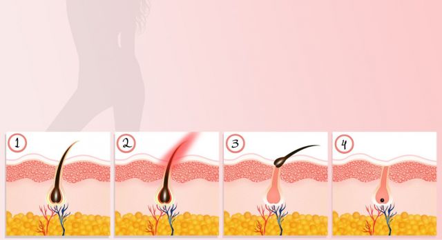 Comment faire la différence entre le laser et la lumière pulsée professionnelle ?