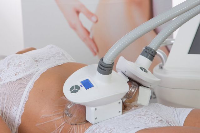 Cryolipolyse résultat avant après chez ByVinca à Paris 14