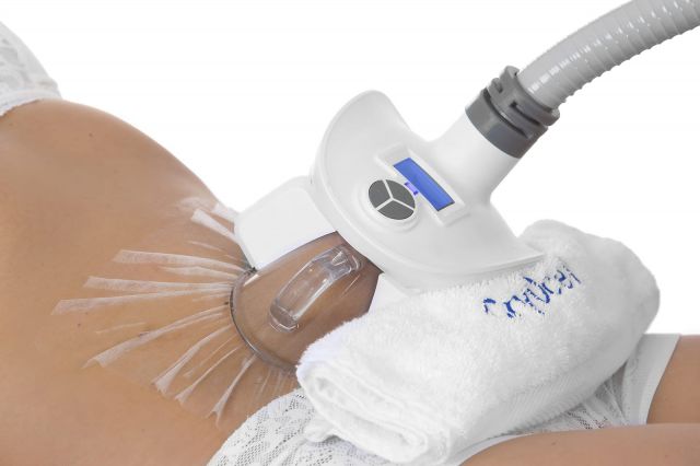 Cryolipolyse résultat avant après chez ByVinca à Paris 14