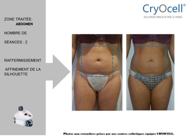 Cryolipolyse ventre ByVinca Paris 14