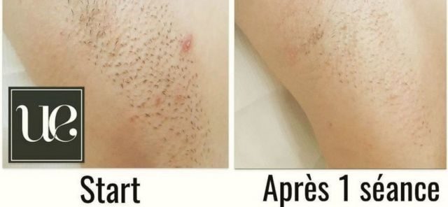 Epilation définitive Avant/Après ByVinca Paris 14