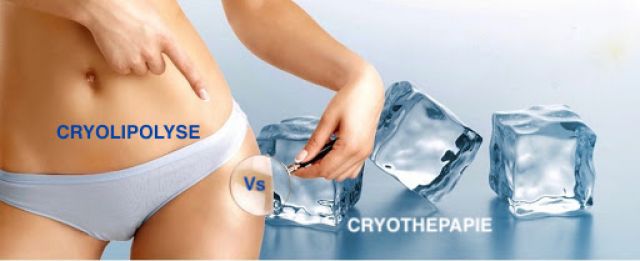 Maigrir par cryolipolyse à Paris 14