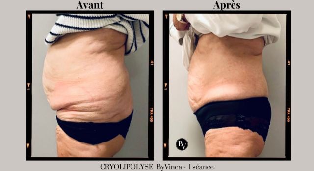 Cryolipolyse Avant /Après 1 séance ByVinca Paris